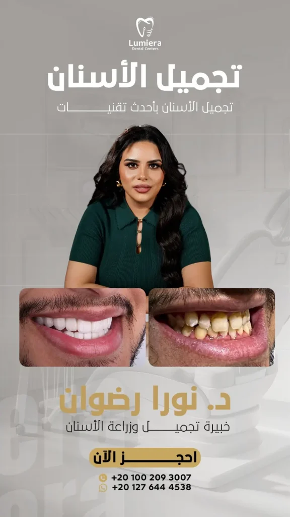 عمليات تجميل الأسنان بدون تقويم
