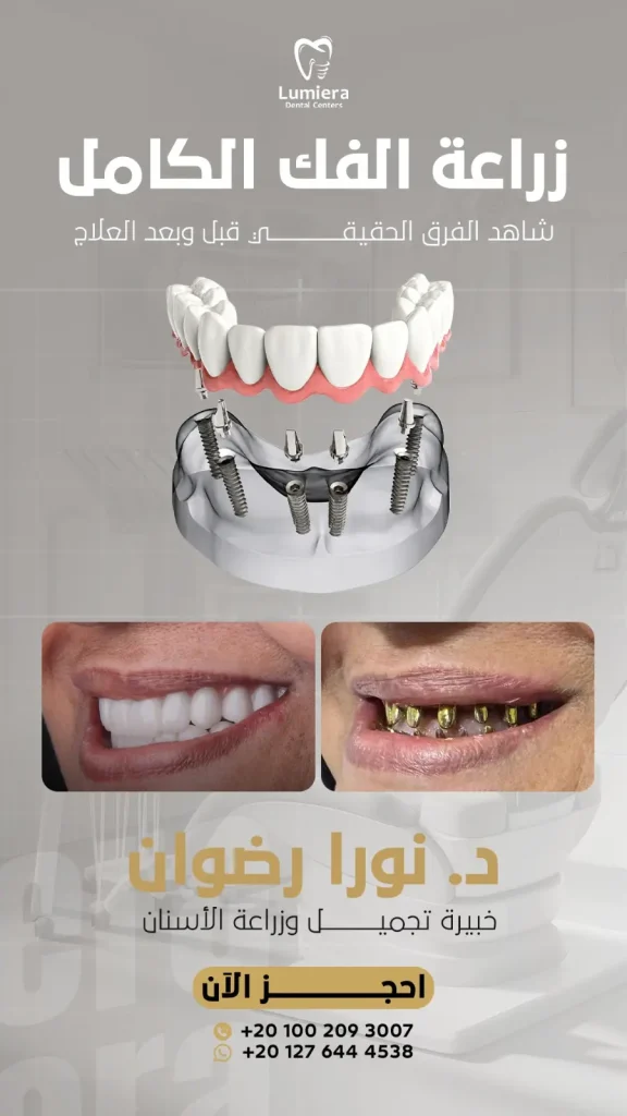 زراعة الفك