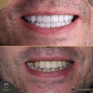 انواع تجميل الاسنان