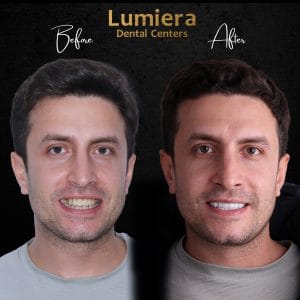 الابتسامة اللثوية قبل وبعد
