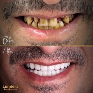naTURAL vENEER - 3