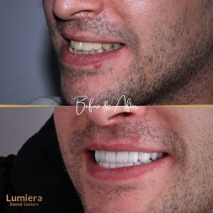 naTURAL vENEER - 4