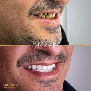 naTURAL vENEER - 5