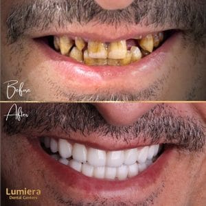 تركيب أسنان سيراميك ثابتة
