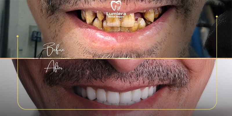 زراعة الأسنان