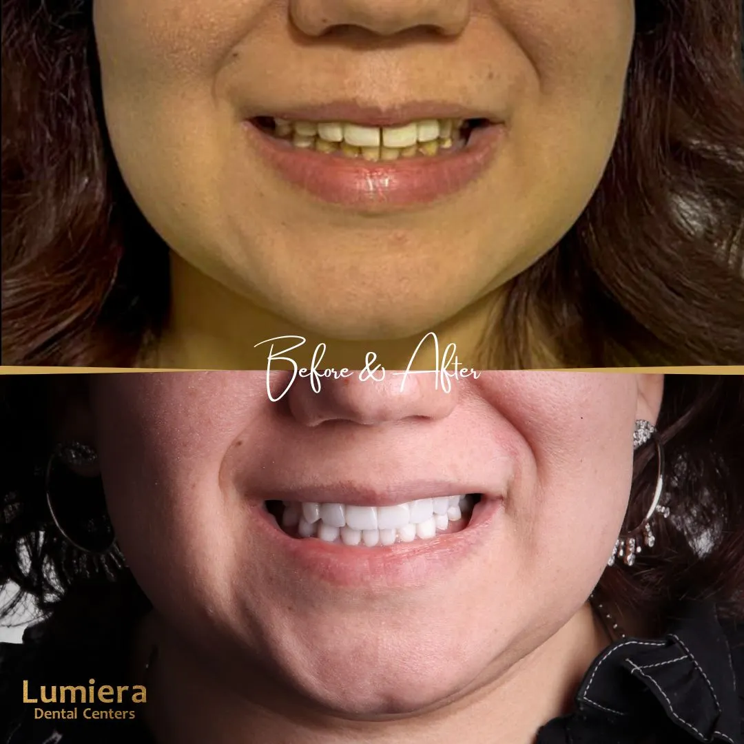 فوائد زراعة اسنان