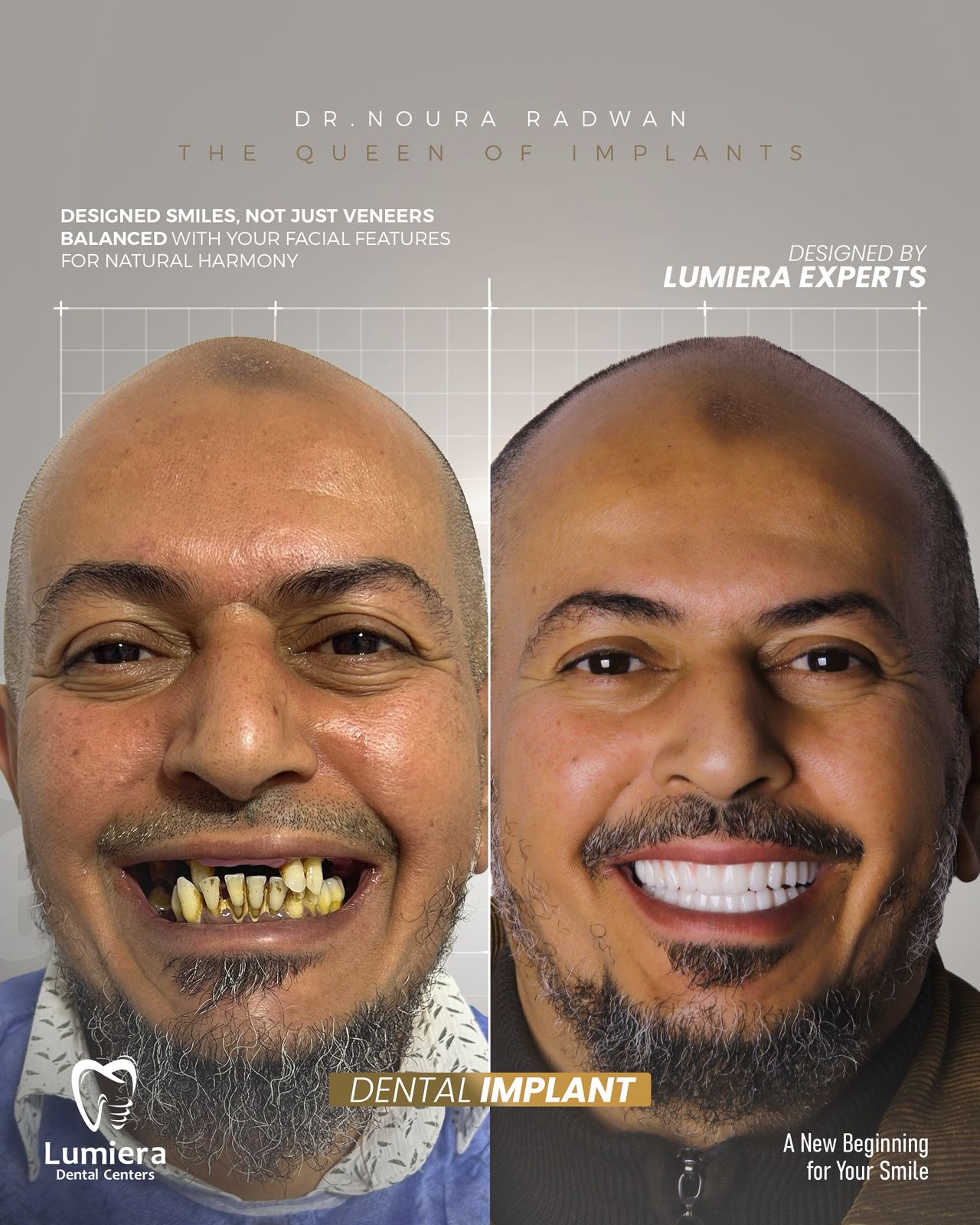 زراعه فكين و ابتسامه هوليود ع الزرعات